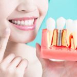 Top 10 nha khoa cấy ghép răng Implant tốt nhất huyện Nhà Bè