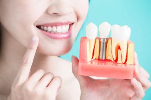 Read more about the article Top 10 nha khoa cấy ghép răng Implant tốt nhất huyện Nhà Bè