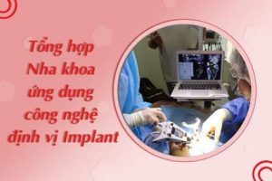 Read more about the article Tổng hợp các nha khoa ứng dụng công nghệ định vị Implant