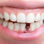 Top 10 nha khoa cấy ghép răng Implant tốt nhất huyện Bình Chánh