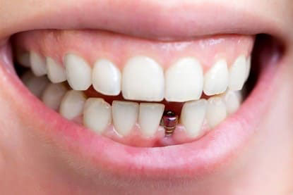 Read more about the article Top 10 nha khoa cấy ghép răng Implant tốt nhất huyện Bình Chánh