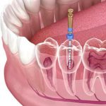Top 10 nha khoa điều trị tủy răng uy tín nhất huyện Bình Chánh