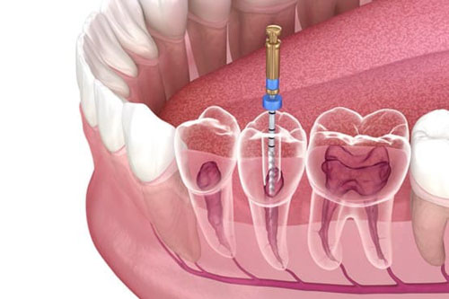 Nha khoa điều trị tủy răng uy tín nhất huyện Bình Chánh