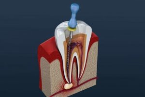 Read more about the article Top 10 nha khoa điều trị tủy răng uy tín nhất huyện Nhà Bè