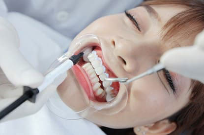 Quy trình thực hiện an toàn, không làm tổn thương đến men răng và nướu. Ảnh minh họa