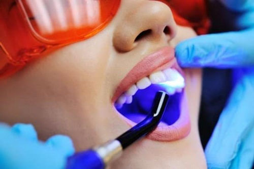 Trám răng thẩm mỹ là một trong những dịch vụ chuyên sâu của nha khoa Long Thới. Ảnh minh họa