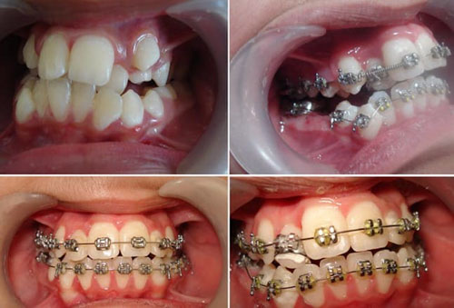 Hình ảnh niềng răng với mắc cài kim loại 2