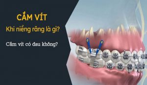 Read more about the article Bắt vít niềng răng là gì? Khi nào cần thực hiện?
