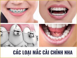 Read more about the article Các loại mắc cài niềng răng được sử dụng phổ biến