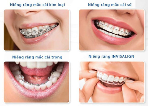Các phương pháp niềng răng phổ biến