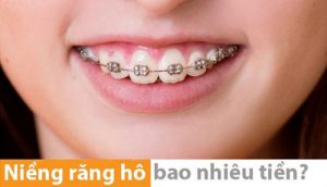 Read more about the article Chi phí niềng răng hô là bao nhiêu?