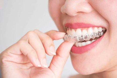Chi phí niềng răng Invisalign thường phụ thuộc nhiều yếu tố