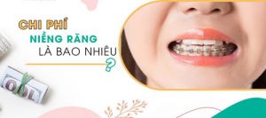 Read more about the article Bảng giá chi phí niềng răng chỉnh nha ở nha khoa