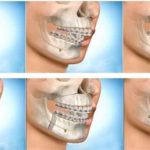 Chỉnh răng hô hàm trên bằng phương pháp nào hiệu quả?