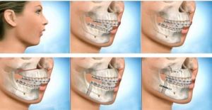 Read more about the article Chỉnh răng hô hàm trên bằng phương pháp nào hiệu quả?