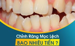 Read more about the article Chỉnh răng mọc lệch bao nhiêu tiền?