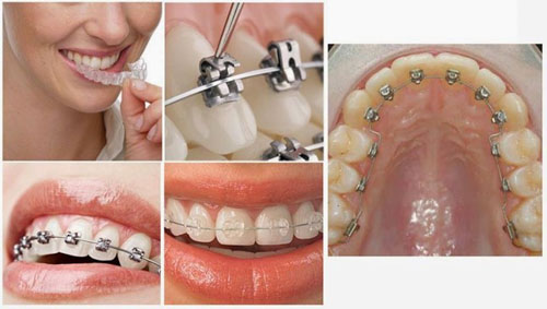 Đa dạng phương pháp niềng răng