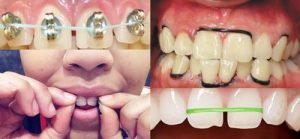 Read more about the article Dụng cụ kéo răng hô tại nhà có thực sự hiệu quả không?