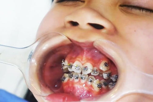 Mức độ sai lệch của răng ảnh hưởng nhiều đến thời gian niềng răng