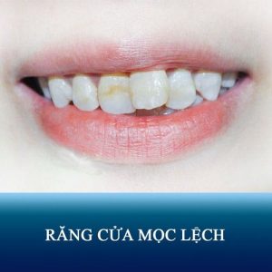 Read more about the article Nguyên nhân răng cửa mọc lệch và cách khắc phục hiệu quả