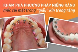 Read more about the article Những điều cần biết về niềng răng mặt trong