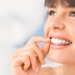 Niềng răng bằng nhựa là gì, có hiệu quả không?