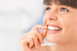 Read more about the article Niềng răng bằng nhựa là gì, có hiệu quả không?