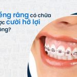 Niềng răng chữa cười hở lợi có được không?