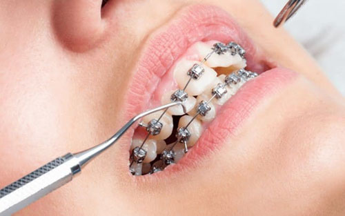 Niềng răng có làm răng yếu đi không phụ thuộc nhiều yếu tố