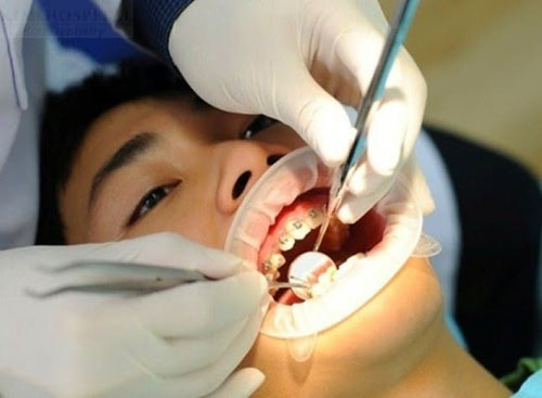 Niềng răng đòi hỏi tay nghề bác sĩ phải chuẩn xác, dùng lực kéo phù hợp