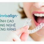 Niềng răng Invisalign và những điều cần biết