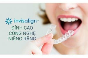 Read more about the article Niềng răng Invisalign và những điều cần biết