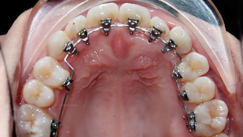 Niềng răng mặt trong với các khí cụ được gắn ở mặt trong thân răng
