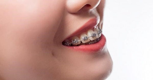 Niềng răng xong bị hô là tình trạng phổ biến ở nhiều bệnh nhân