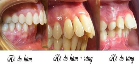 Phẫu thuật hàm vẩu trong trường hợp do hàm hoặc do răng và hàm