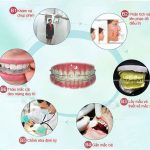 Quy trình niềng răng khểnh diễn ra như thế nào?