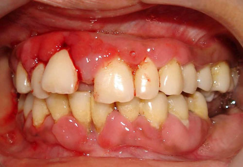 Răng mọc sai lệch gây nhiều nguy hại cho sức khỏe răng miệng