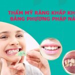 Thẩm mỹ răng khấp khểnh bằng phương pháp nào hiệu quả?