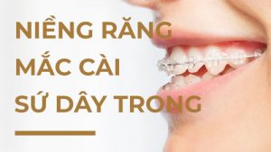 Read more about the article Tìm hiểu phương pháp niềng răng mắc cài sứ dây trong