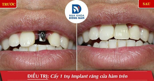 Trồng răng Implant giúp phục hình răng một cách tốt nhất