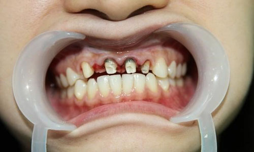 Dùng răng giả kém chất lượng gây viêm chân răng thật