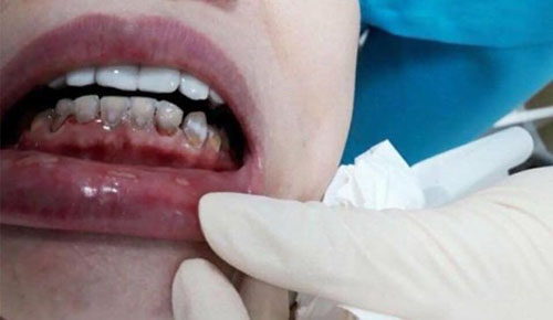Phủ sứ sai cách hư răng thật