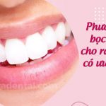 Bọc răng sứ cho răng khểnh có hiệu quả không?