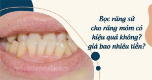 Read more about the article Bọc răng sứ cho răng móm có hiệu quả không? Giá bao nhiêu tiền?