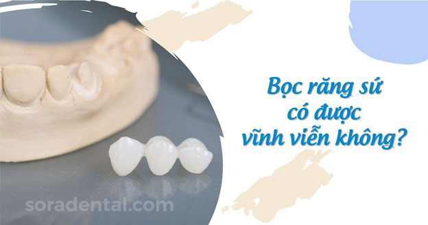 Read more about the article Bọc răng sứ có được vĩnh viễn không? Khi nào thay mới?