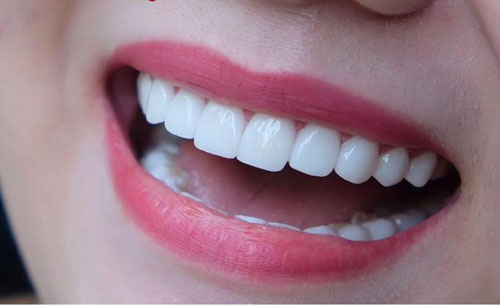 Bọc răng sứ giúp khắc phục các khuyết điểm của răng