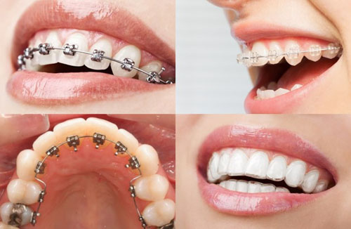 Các phương pháp niềng răng
