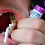 Trám răng tại nhà có được không? có thật sự an toàn?
