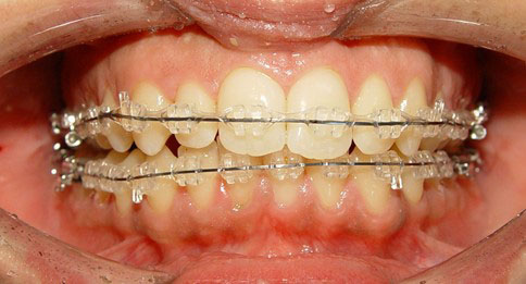 Chi phí niềng răng mắc cài sứ phụ thuộc vào từng tình trạng của răng