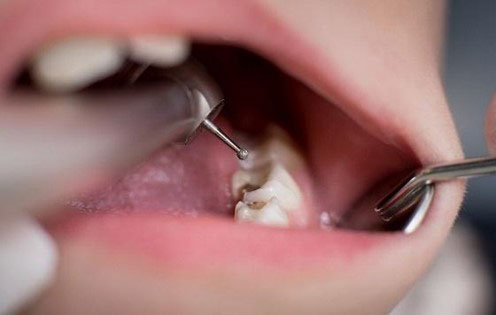 Chi phí trám răng mẻ phụ thuộc nhiều yếu tố